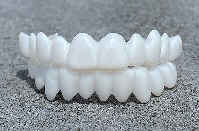 Charly | DentAlign Dental Veneers – Natural Fit and Comfort