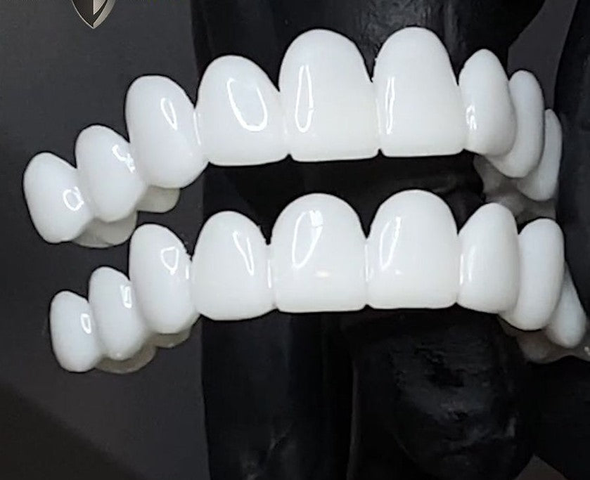 Charly | DentAlign Dental Veneers – Natural Fit and Comfort