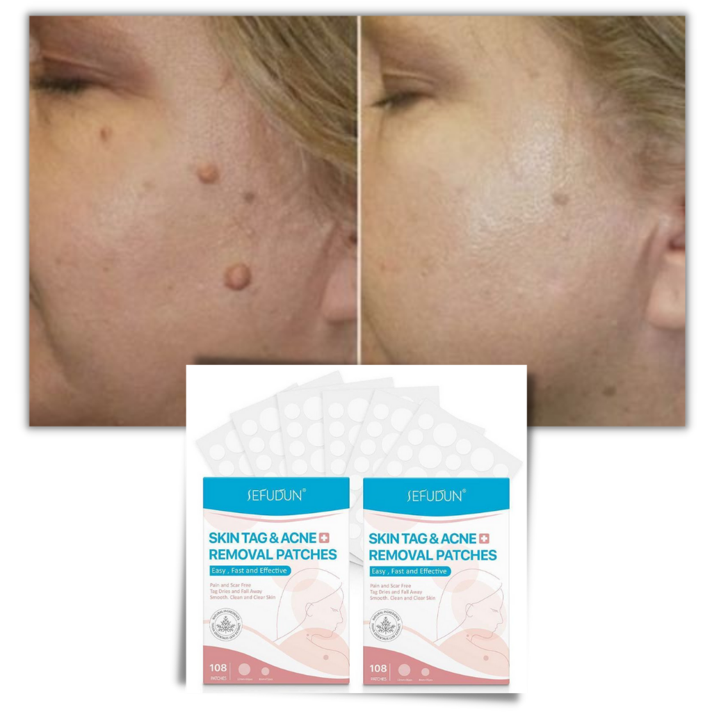 Charly | Skin Patch - Remove Moles and Warts Naturally!