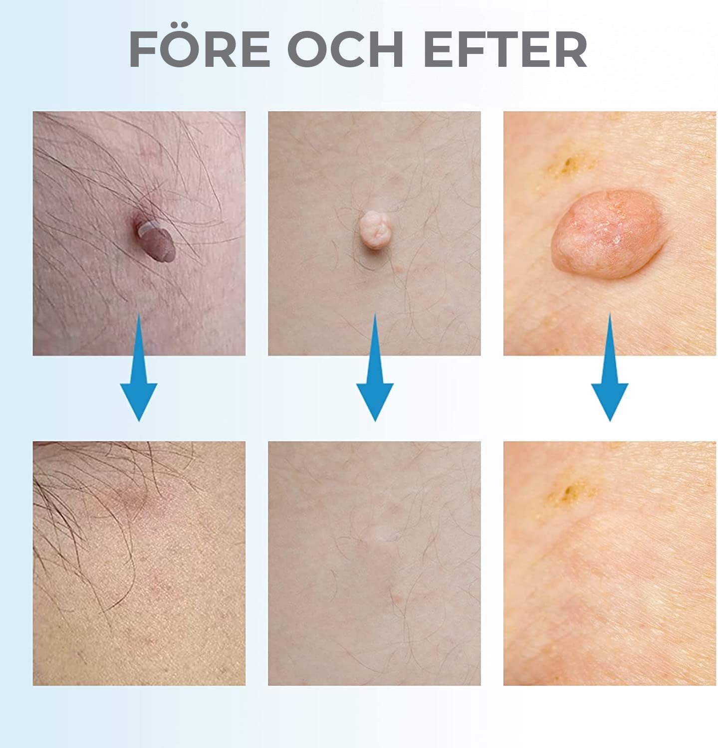 Liver Spot Removal - Removal of Birthmarks